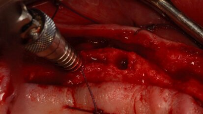 Wykorzystanie techniki poszerzania i kondensacji kości