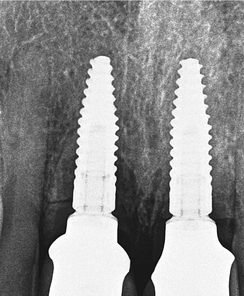 Slika 10. Pojedinačna snimka zuba nakon dva mjeseca: vestibularni fragment još uvijek je prepoznatljiv. 