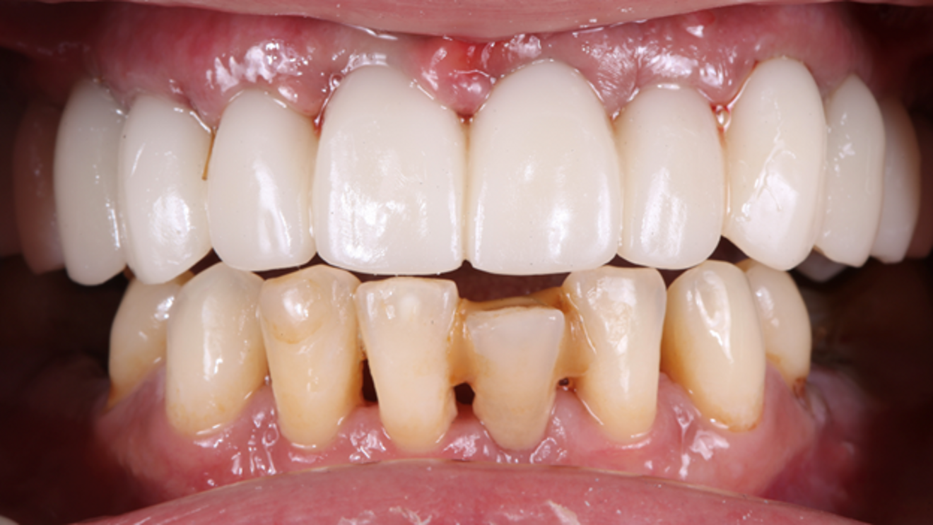 Fig. 5: 3D-printed maxillary prosthesis after insertion on the day of surgery.