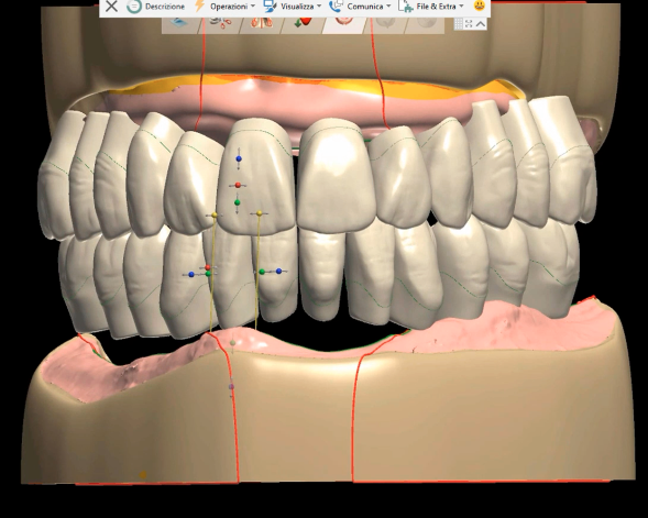 Fig. 6_La protesi superiore e inferiore disegnate con le librerie Ivoclar Ivotion.