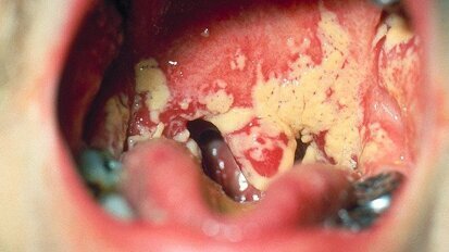 Cientistas descobrem micro-organismos que previnem infecção bucal