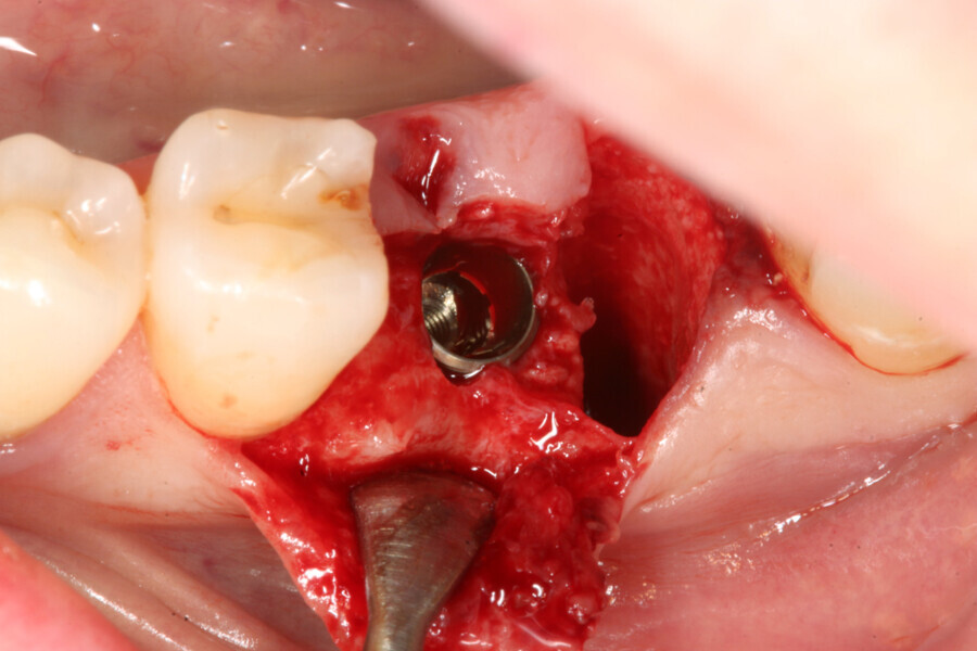 Fig. 5: Implant in final position. 