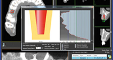 EGIS, novedades en cirugía implantoprotésica guiada