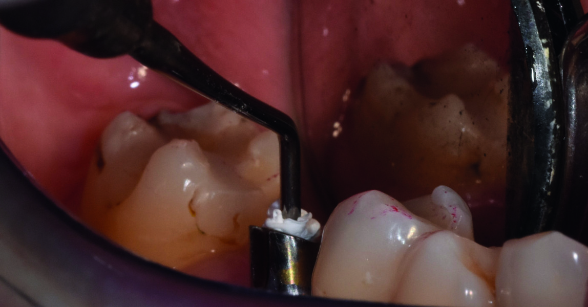 Fig. 24 : D’un côté fouloir cylindre pour remplir le fût avec le téflon.