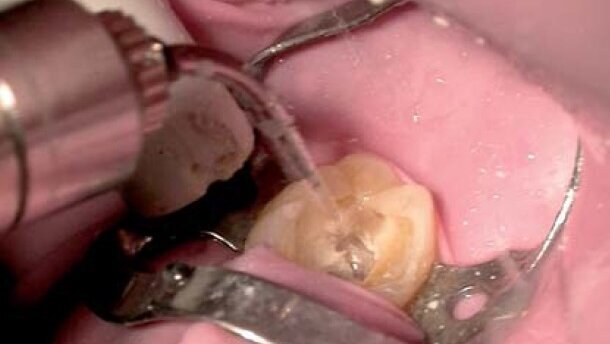 Zastosowanie laserów w stomatologii dziecięcej