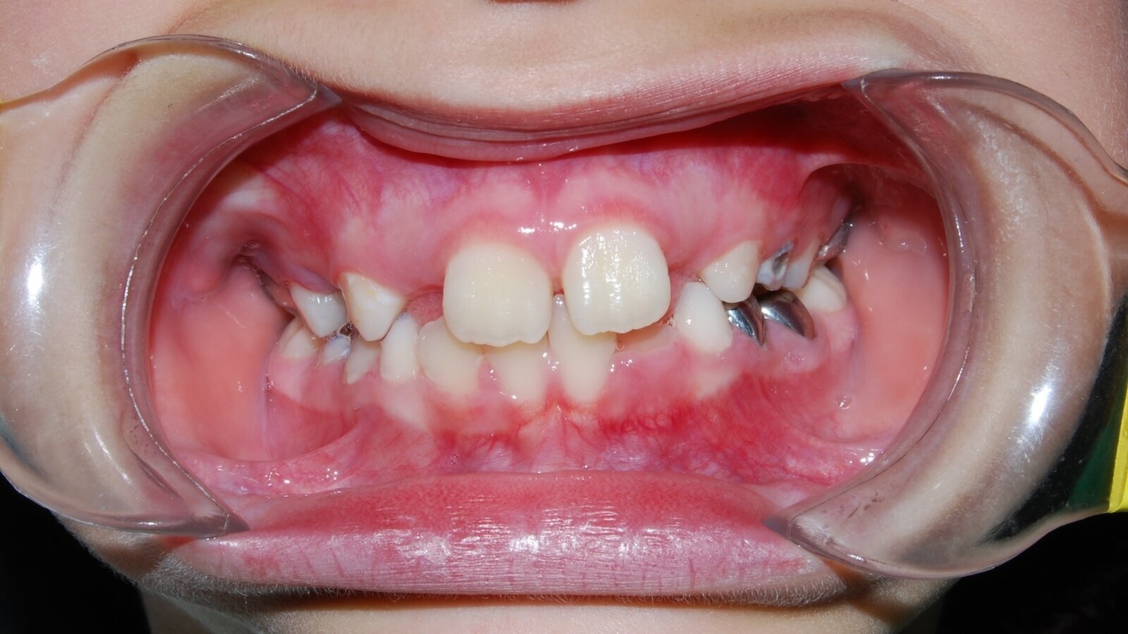 Abordaje odontológico del Síndrome de Prader-Willi: Desafíos y consideraciones clínicas