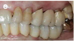 Fig. 14e: Occlusal, frontal and lateral views on the day of delivery, showing healthy peri-implant mucosal conditions (a) and the final CAD/CAM restoration in situ (b–e).
