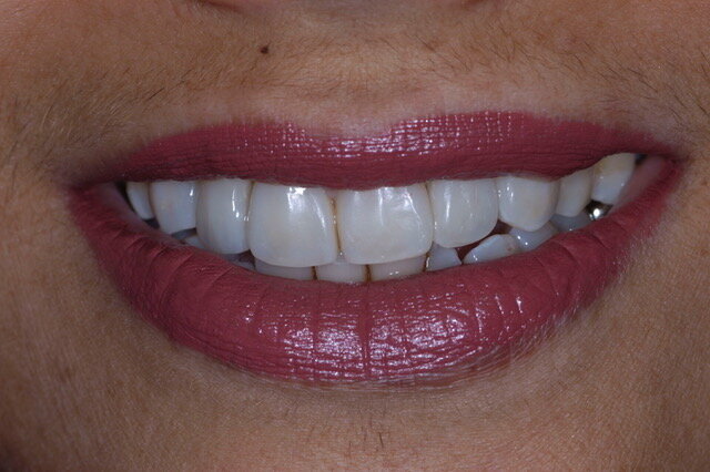 Fig 1B: Frontal smile view: After