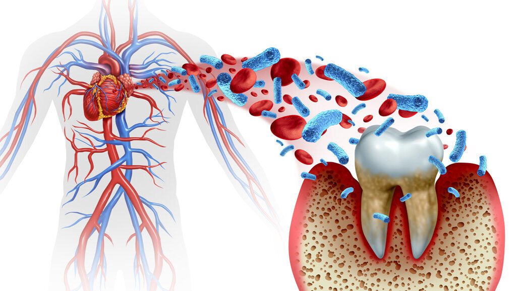 Alle vier großen Volkskrankheiten sind mit Parodontitis assoziiert