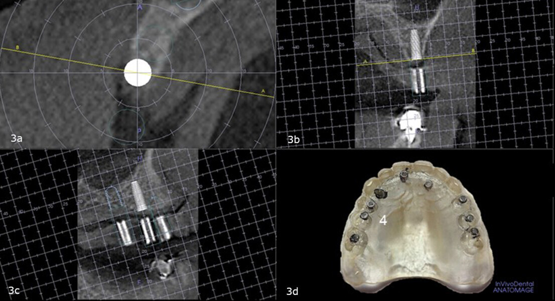 Figs. 3a–d: Virtual planning with the diagnostic guide placed intra-orally during the CBCT scan showing sufficient bone to accommodate an implant in the maxillary right second premolar site and no need for angular or linear correction (a–c). Site on the duplicate denture (d).