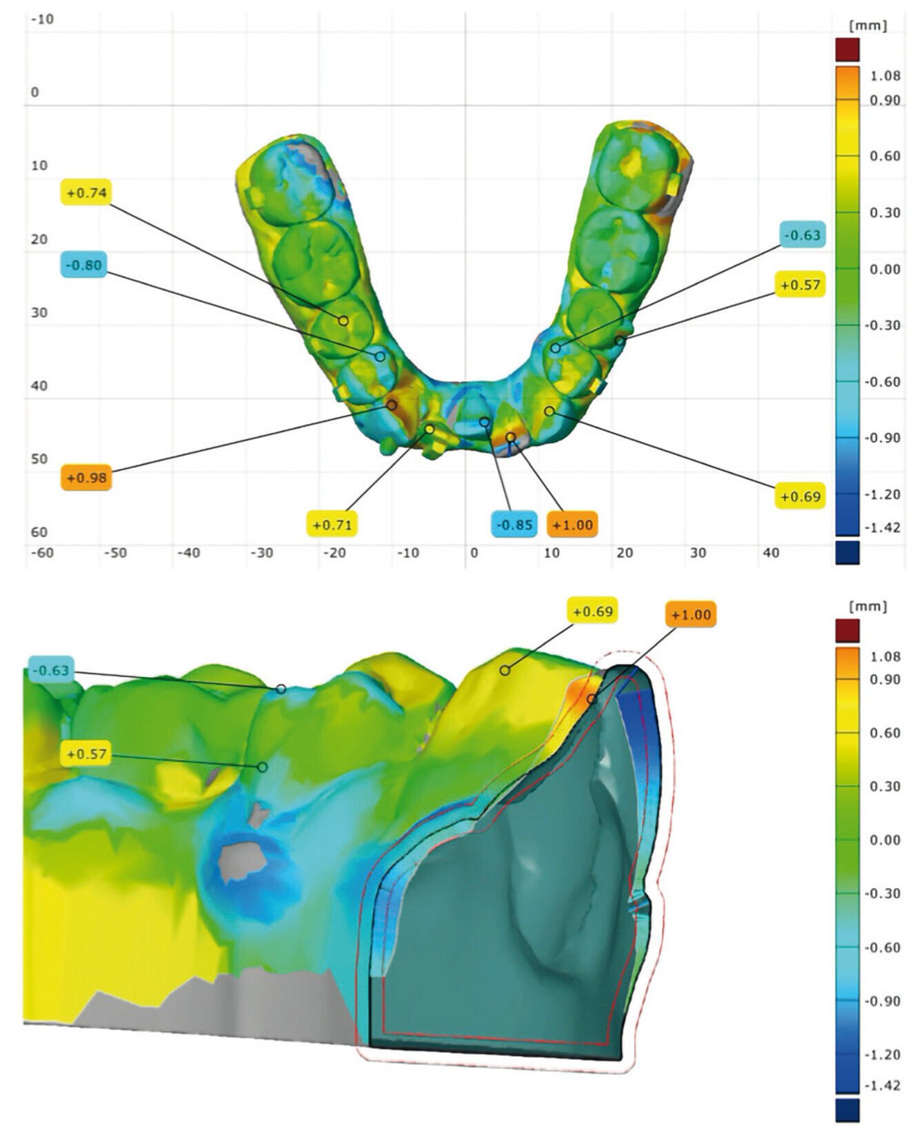 Fig. 24: Treatment evaluation report for the mandibular arch. Deviation analysis was done by superimposing the simulated treatment stage data in the CAD software on to the actual data obtained by scanning the patient’s teeth at the end of the third phase of the treatment.