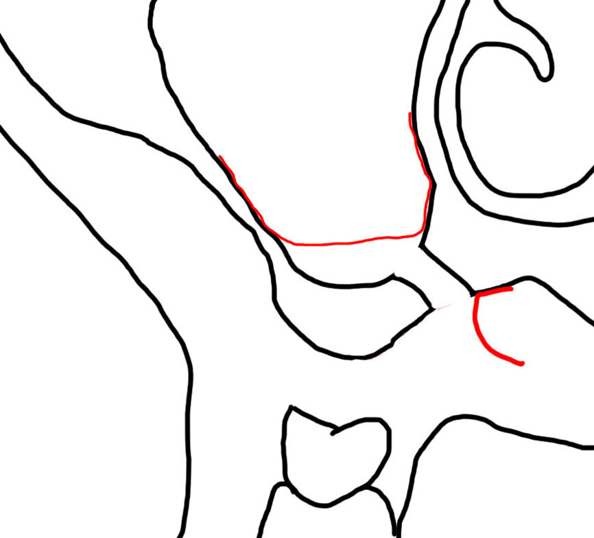 Ryc. 2 b_Wytworzenie okna kostnego od strony podniebiennej, uwidaczniając nienaruszoną membranę Schneidera.