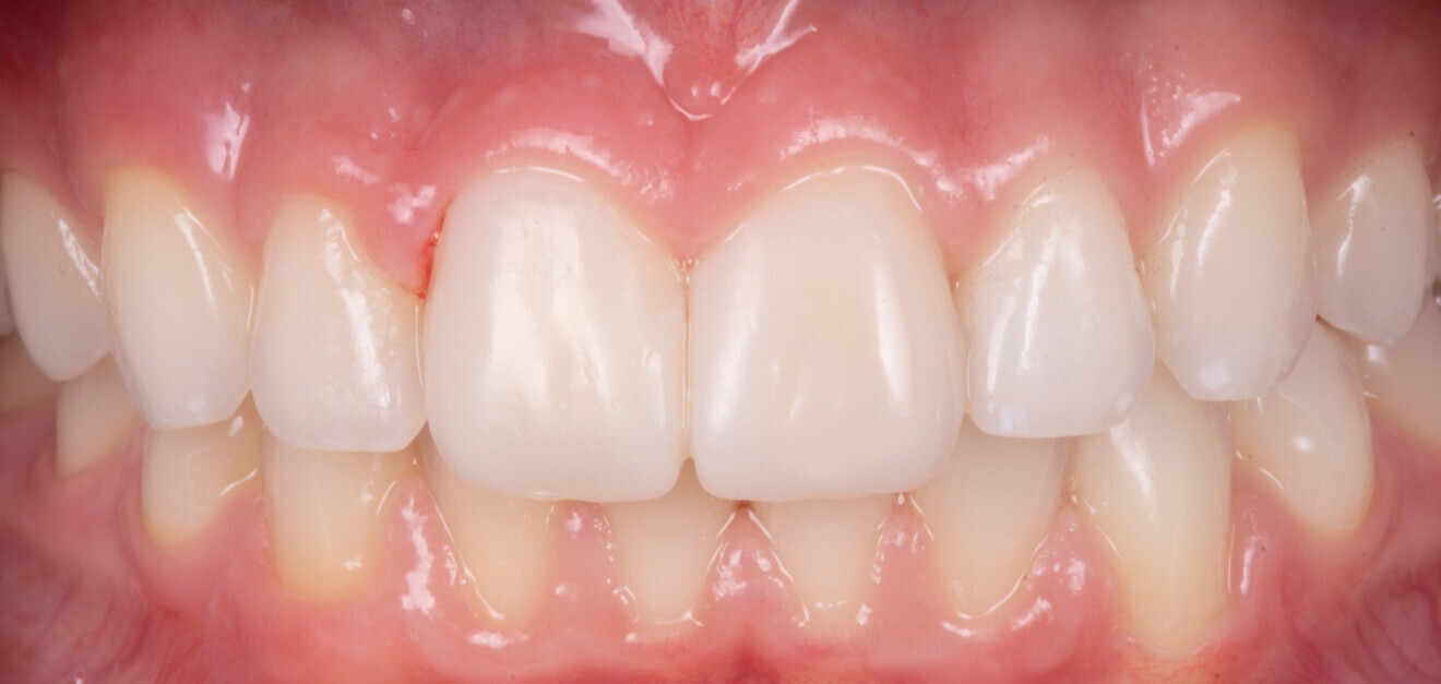 Fig. 22 : Photo du résultat à sept jours, formes, couleurs et textures retrouvant une uniformité.