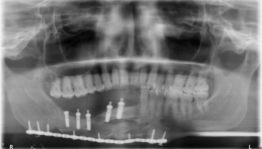 Fig 2: OPG of a patient 9 years following implant supported dental rehabilitation. Stable marginal bone levels are seen. 