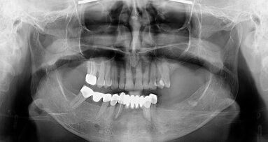 Fully digital prosthetic workflow for mandibular full-arch rehabilitation