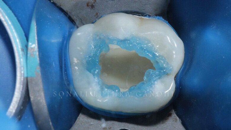 Fig 5: Selective Etching