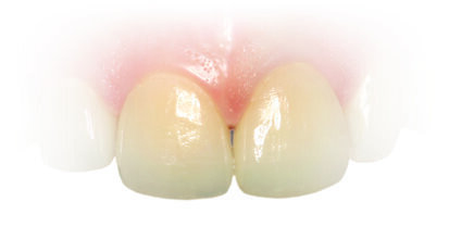 丙烯酸酯被评为“年度过敏原”