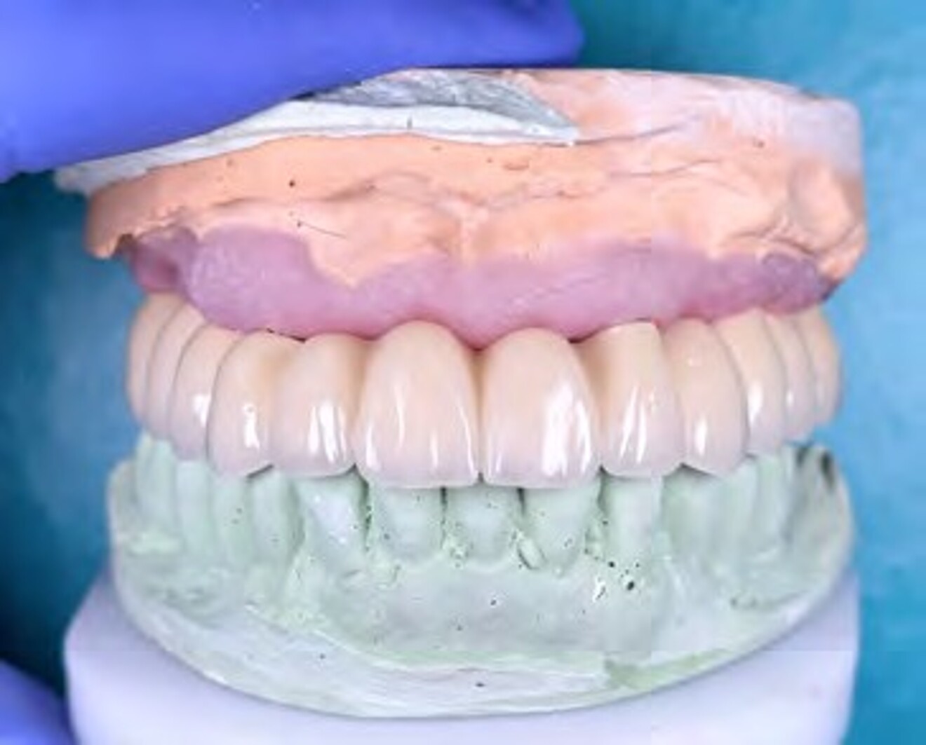 Fig. 3c: Frontal view of the definitive prosthesis mounted on the master cast before clinical delivery. 