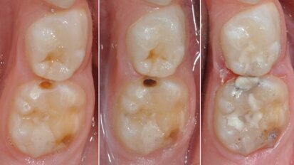Odontoiatria pediatrica  del minimo intervento: istruzioni per l’uso