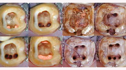 Back to the egg: An evidence-based endodontic implant algorithm Back to the egg: An evidence-based endodontic implant algorithm