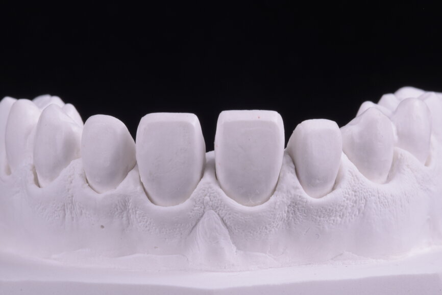 Fig. 61: Alveolar model.