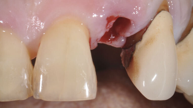Sostituzione immediata mediante impianto e restauro immediato in sede incisivo laterale superiore