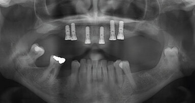 Fáze před ošetřením a význam stabilní parodontální situace