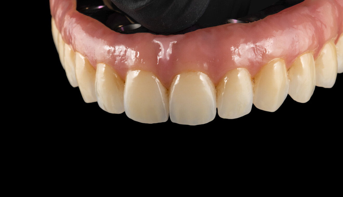 Fig. 13: Bluish 3D effect at the incisal edges, adding visual depth and lifelike appearance to the prosthesis.