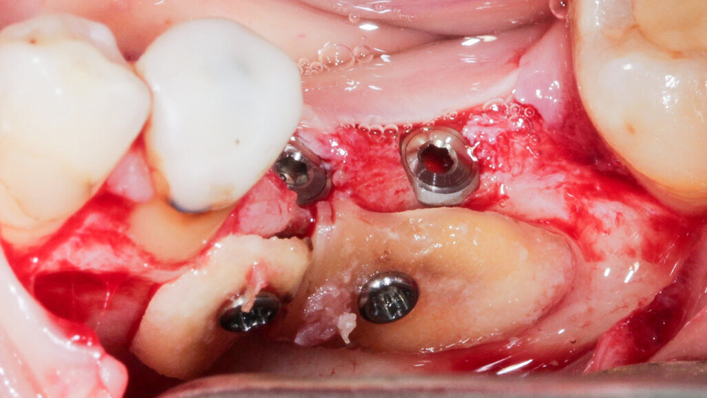 Augmentace pomocí radixu zubu. Použití kořenů zubů v rámci ošetření při nedostatečné nabídce kosti