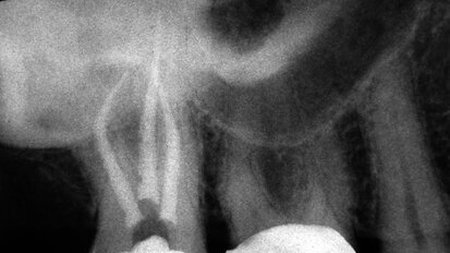 Secrets to better, safer, easier and far less costly endodontics Secrets to better, safer, easier and far less costly endodontics