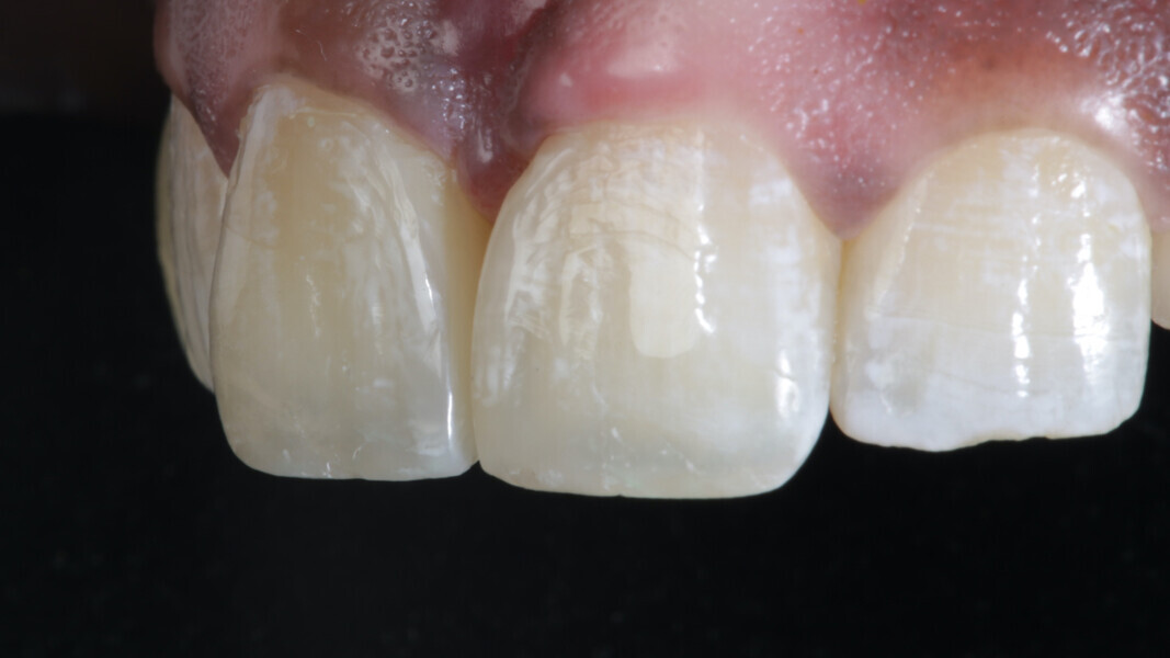 Fig 26. Defining line angles and their perfect contour helps establish an aesthetic shape and hence a pleasing end-result.