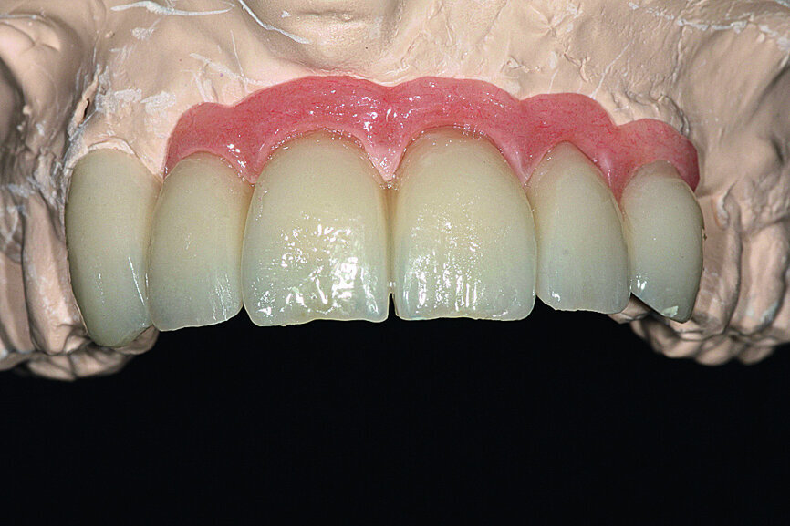 Fig. 27: The cosmetic material placed onto the framework.