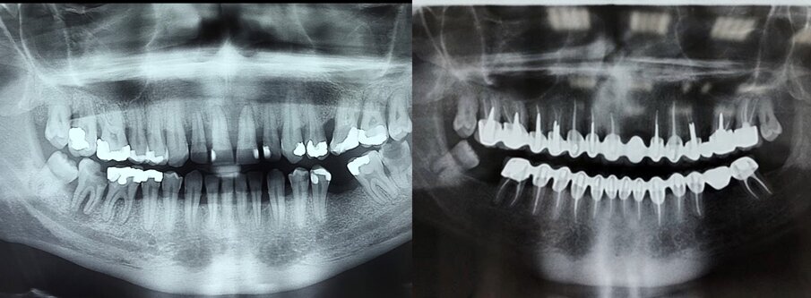 4 Ortopan sa krunicama