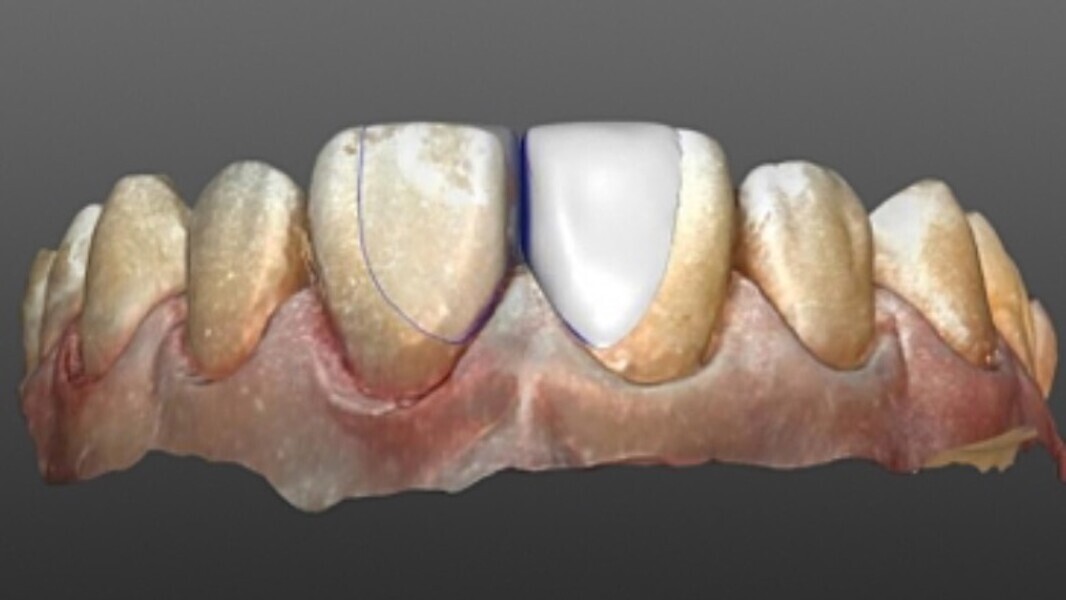 Fig. 2. Las carillas sumamente delgadas se diseñaron en el software inLab.