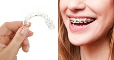 Gouttières transparentes ou appareil dentaire fixe