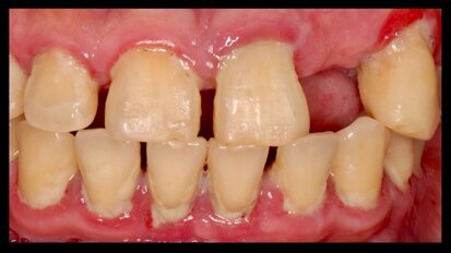 La xerostomía causada por medicamentos