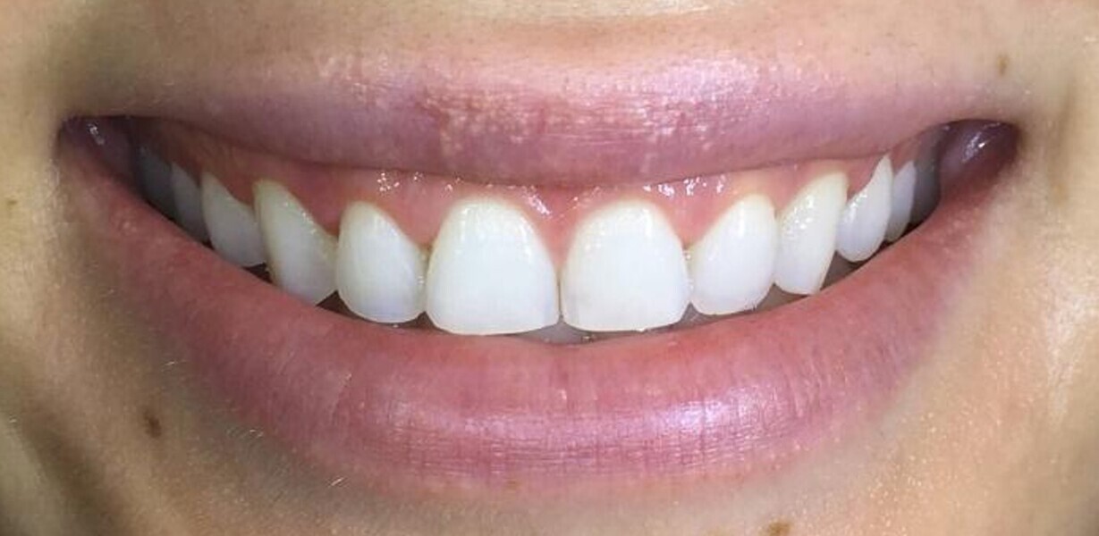 Fig. 12: Close-up view after soft-tissue recontouring, direct restoration and whitening.