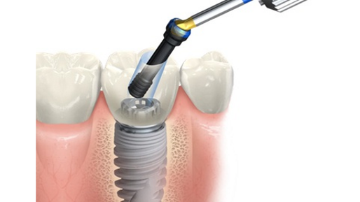 Nobel Biocare – NobelProcera FCZ Implant Crown