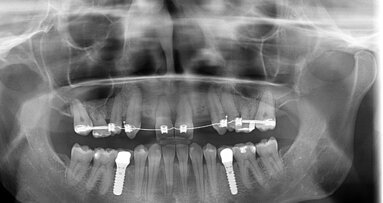 Casus: complexe implantologiebehandeling