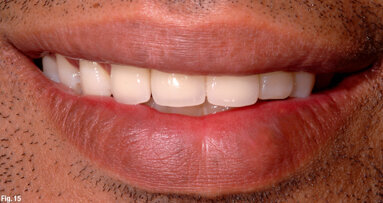 Functional reconstruction and aesthetic management of the anterior maxillary segment