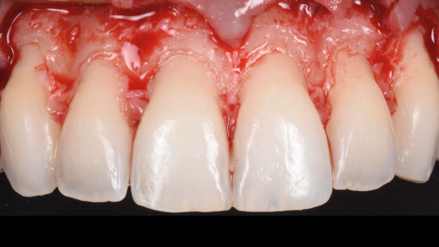 Fig. 14_Rimodellamento osseo dopo chirurgia resettiva.