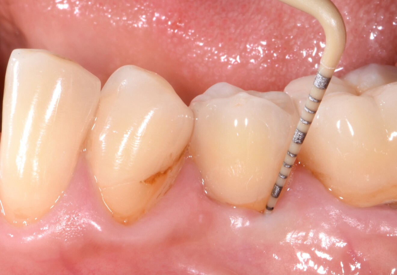 Fig. 3 : Après 4,5 ans de mise en fonction, Patent Symbionic Tooth affiche une profondeur de sondage maximale de 3 mm, valeur comparable à l’état physiologique d’une dent naturelle saine, témoignant de la stabilité des tissus environnants. (Photo : Dr Roland Glauser)