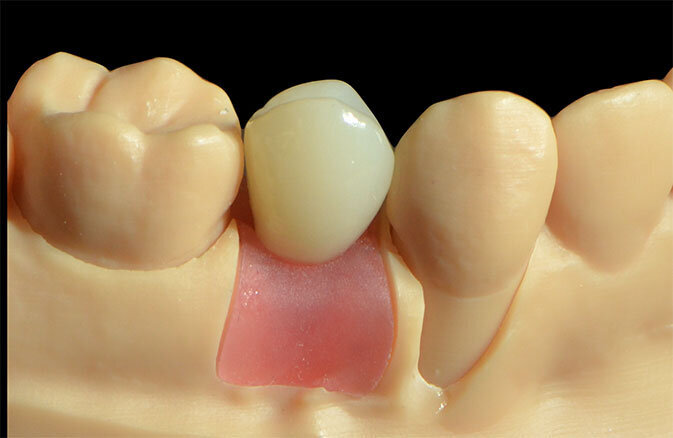 Fig. 16_Il provvisorio avvitato stampato con tecnica DFAB TSLA in materiale Irix MAx Plus.