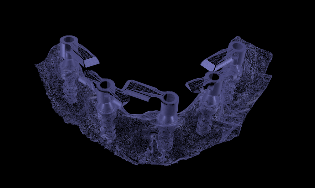 Figs. 13a & b: Digital view of the scan bodies and implant positions (a). Digital design of the definitive restoration (b).