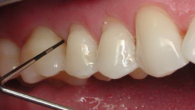 Diode lasers: The soft tissue handpiece