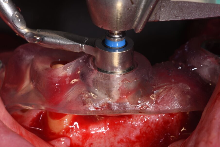 Fig. 20_Visione del secondo elemento in posizione 2.2.