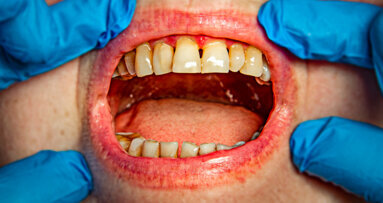 Periodontitis may double chances of cognitive decline, study says