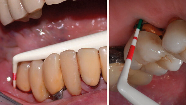 Mantenimento implantare:sondare o no?