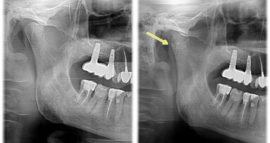 Zastosowanie współczesnych metod diagnostycznych w postępowaniu ze złamaniem CBCT – opis przypadku