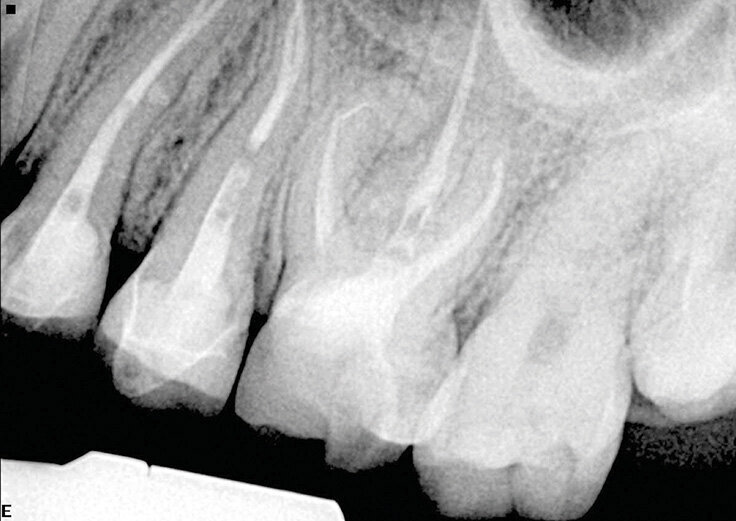 Slučaj 3 – Slika br. 7: Inicijalni periapikalni Rtg snimak